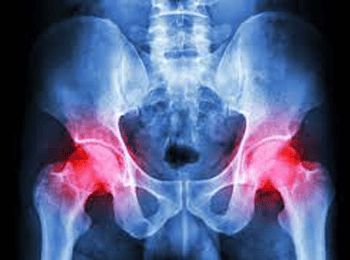 Hip Replacement specialist Gurugram