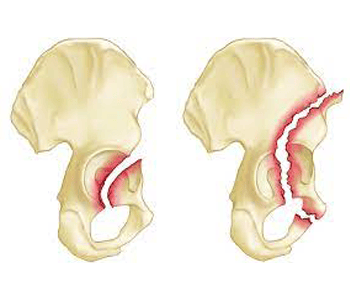 Pelvic Acetabular