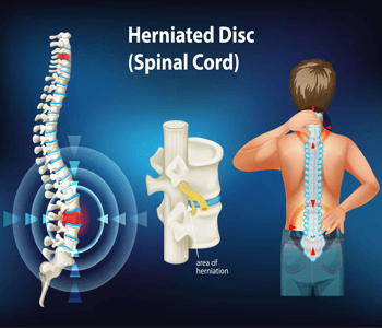 Herniated Disc Treatment/ Slipped Disc Treatment