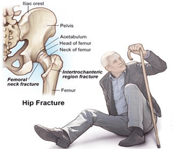 Fracture of the hip