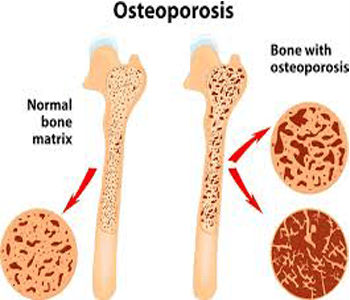 Osteoporosis