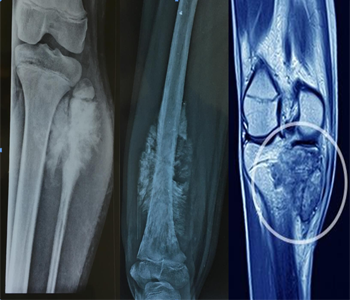 PRIMARY BONE CANCER