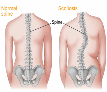 Scoliosis Treatment