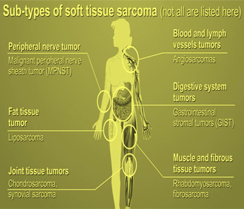 SOFT TISSUE SARCOMA