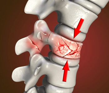 Spine Fracture
